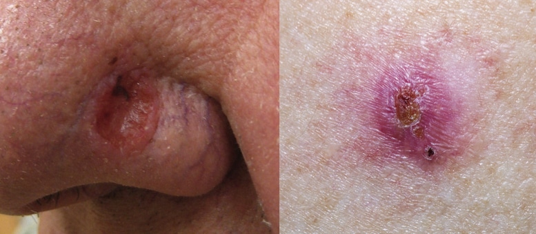 oral basal cell carcinoma