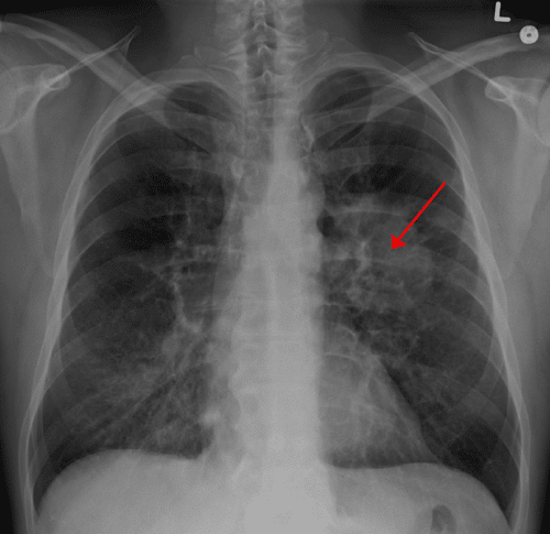radiographic presentation of lung cancer