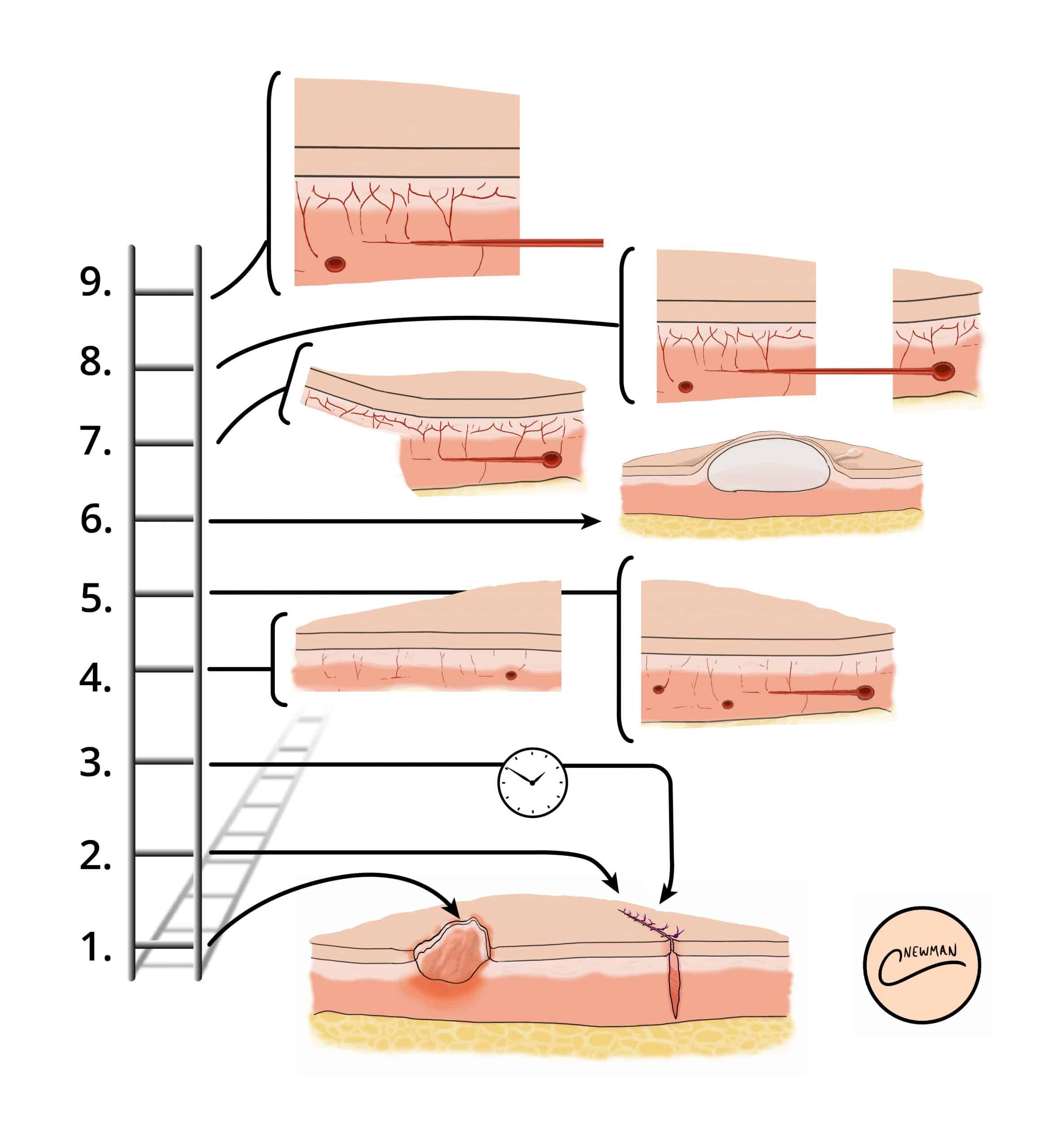 Types Of Surgical Wounds