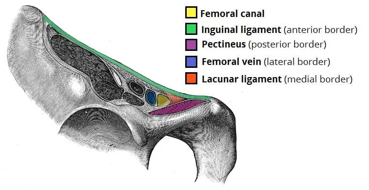 Plug mesh repair of left femoral hernia