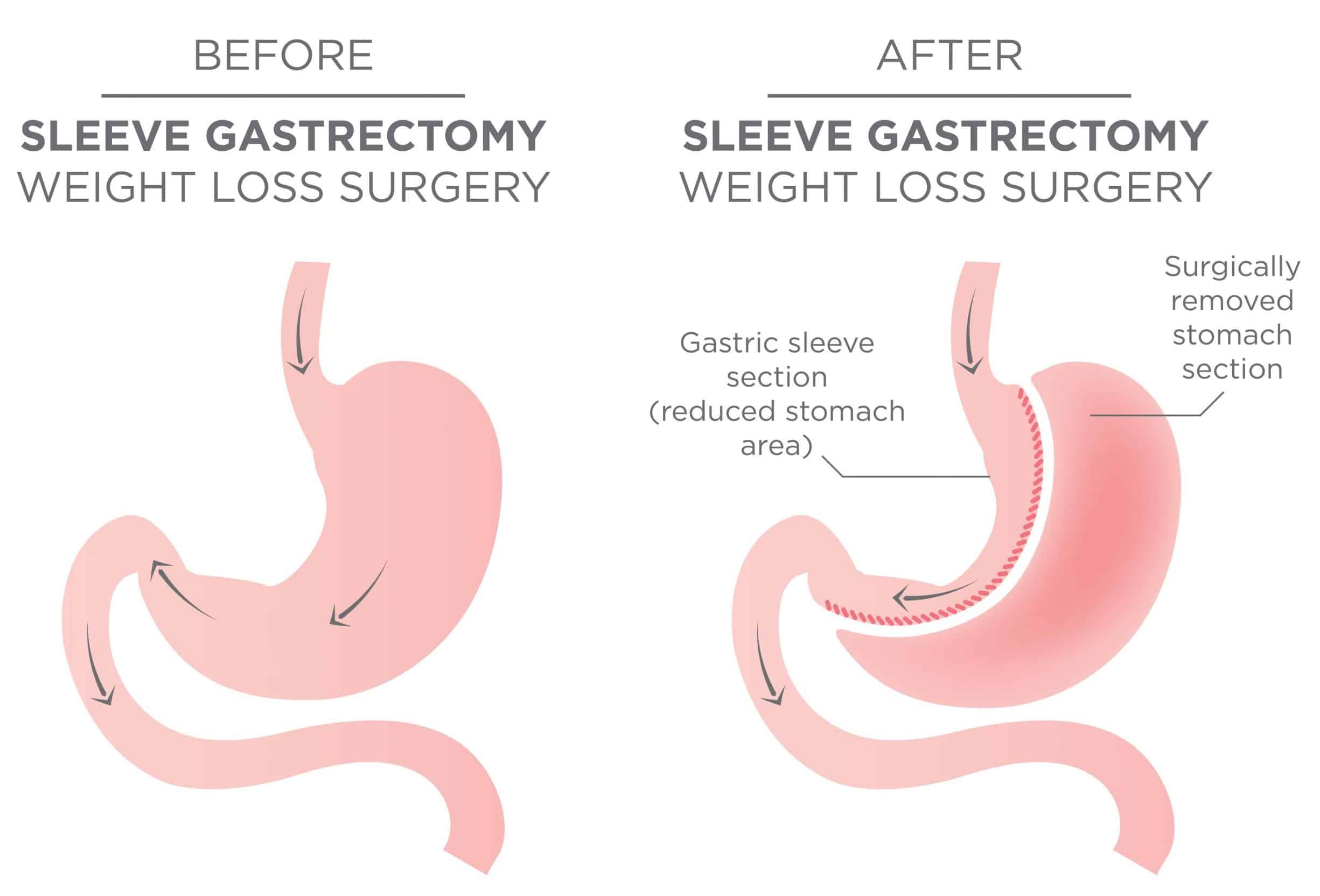 Understanding The Common Gastric Sleeve Complications - The