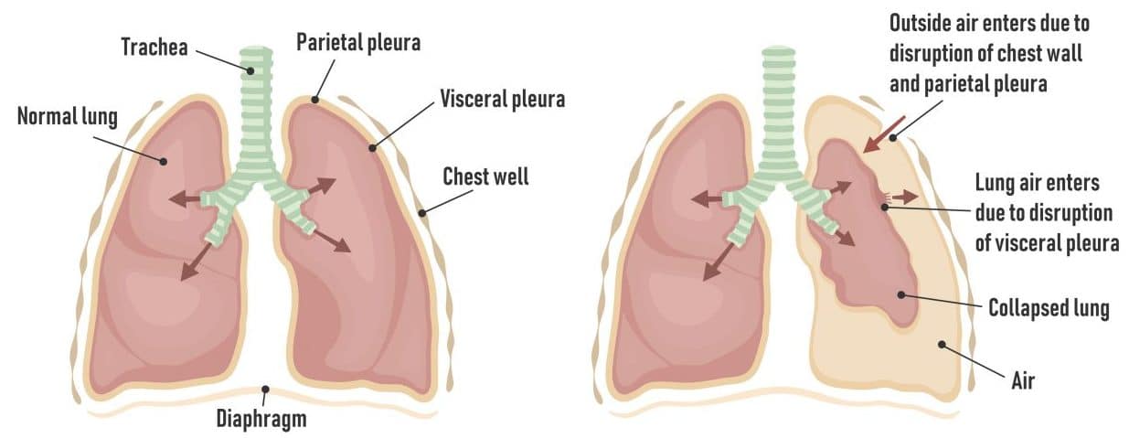 tension pneumothorax mediastinal shift