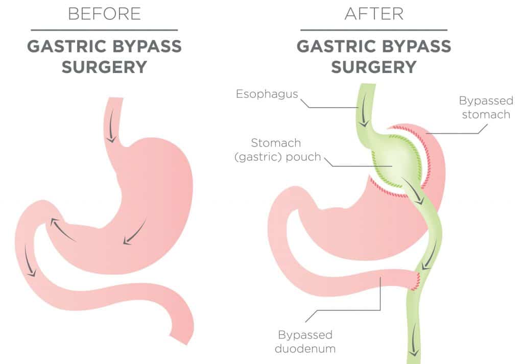 Consent Gastric Bypass TeachMeSurgery