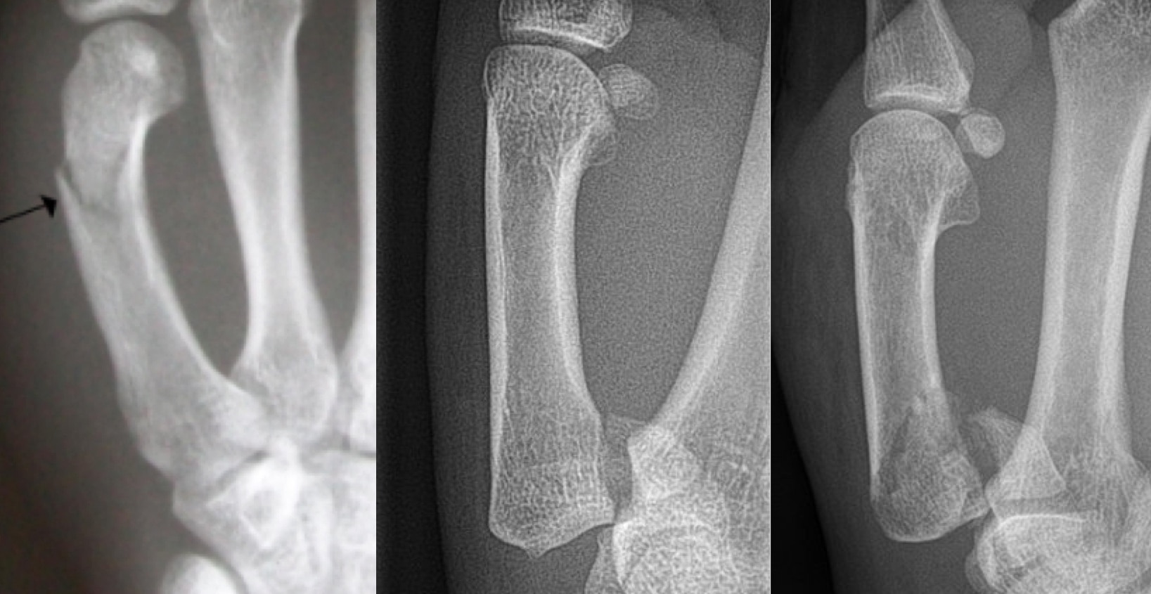 5th Metacarpal Base Fracture