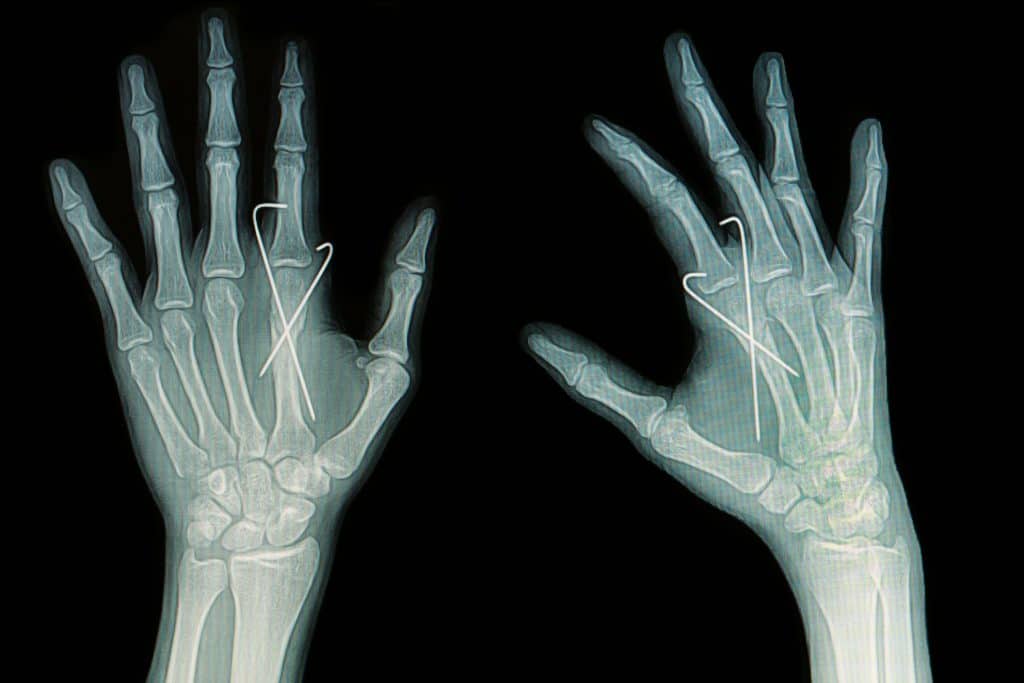 Трещина в кисти. Ушиб пястной кости мизинца. Перелом указательного пальца руки рентген. Трещина на пальце руки рентген.