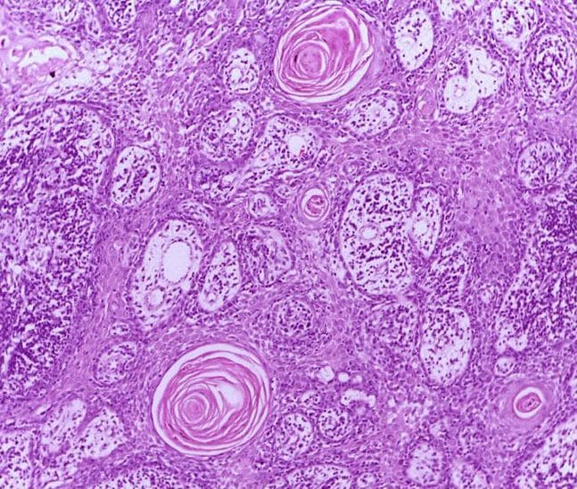 basal cell carcinoma vs squamous cell carcinoma histology