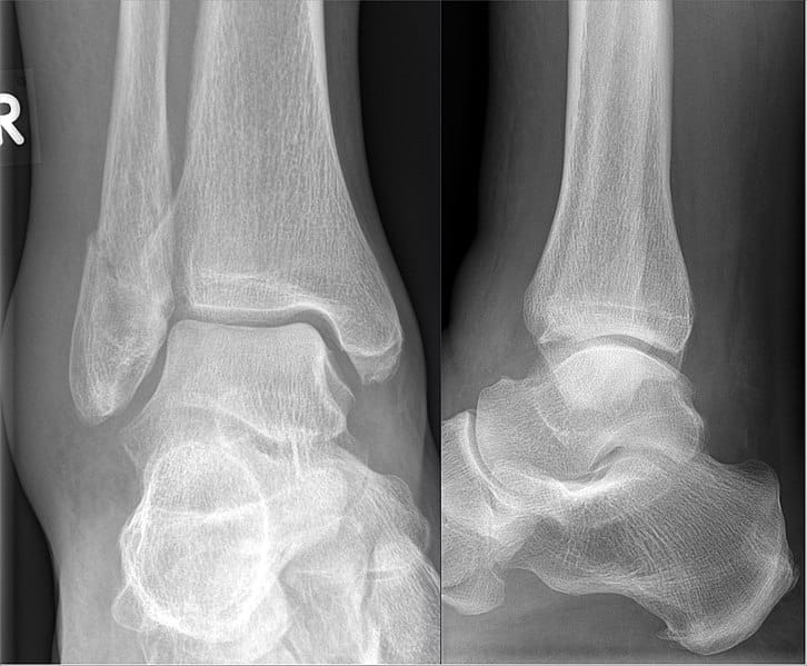 Pott's Fracture (Broken Ankle) - Symptoms, Causes & Treatment