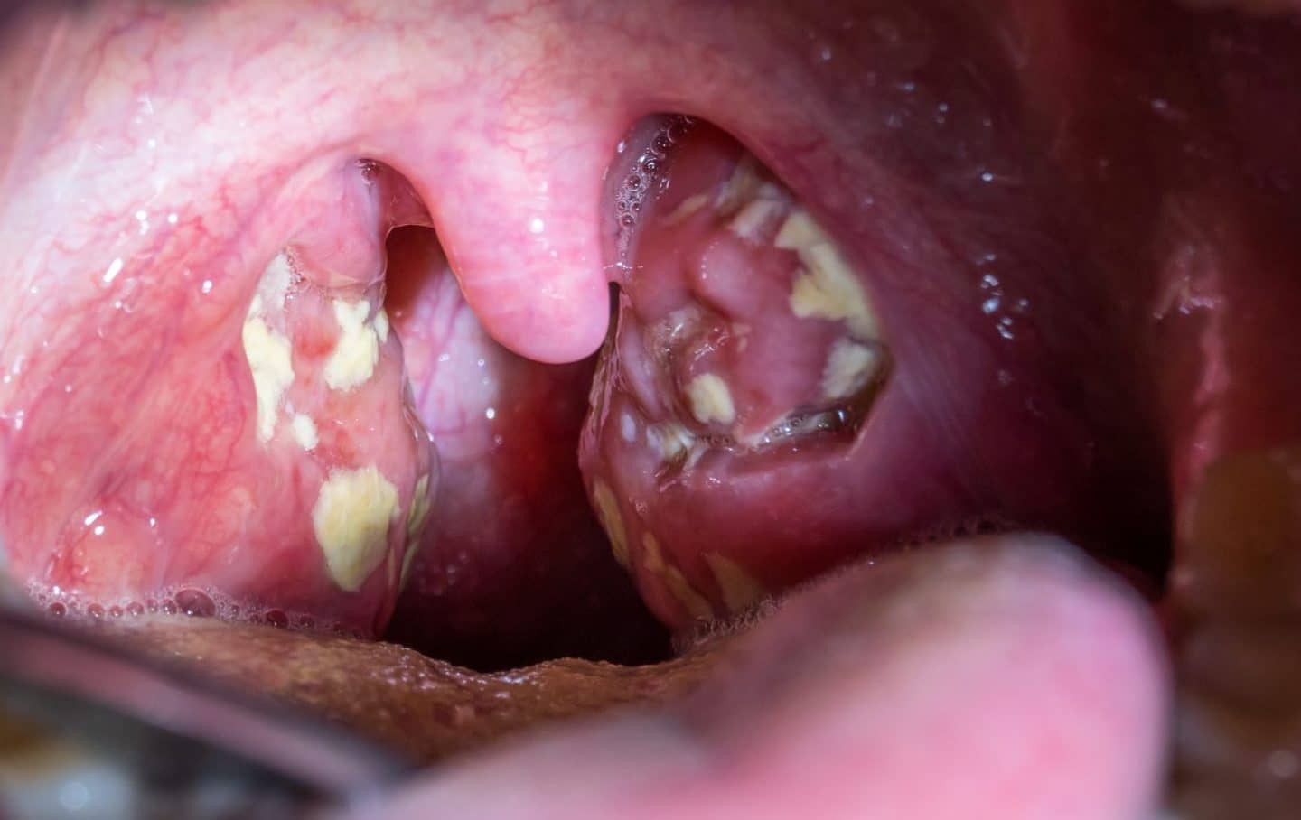 how to get rid of white spots on tonsils
