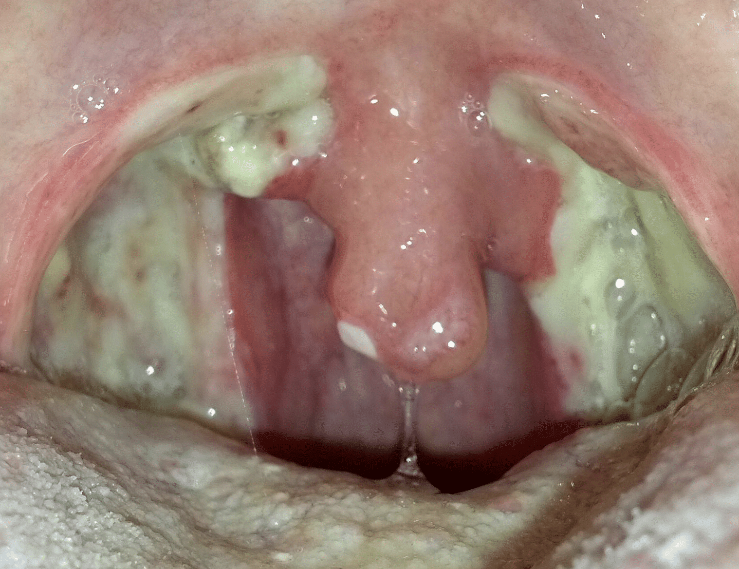 bumps on back of throat