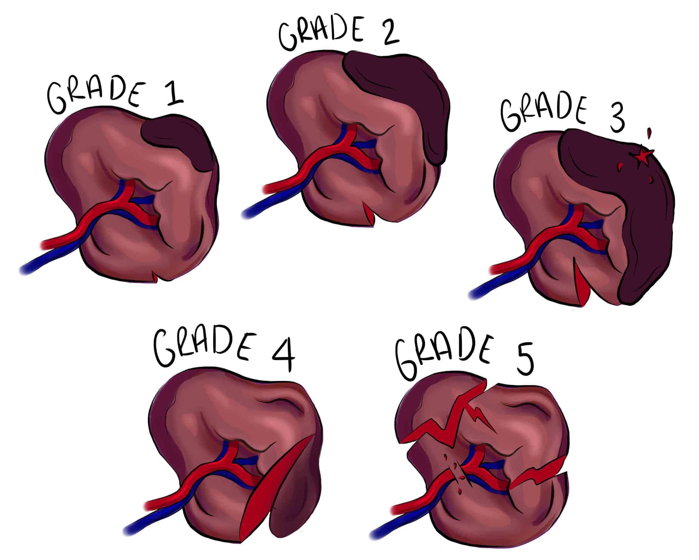 Medial Collateral Ligament Tear - Grading - Management - TeachMeSurgery