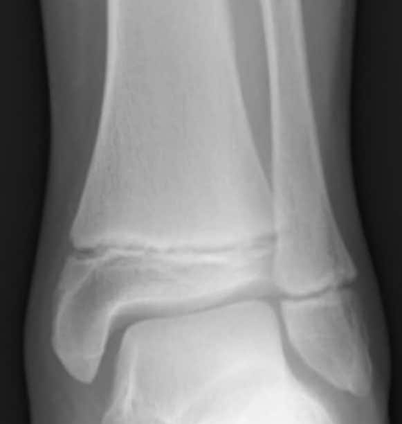 Ankle Fractures - Management - Reduction - TeachMeSurgery