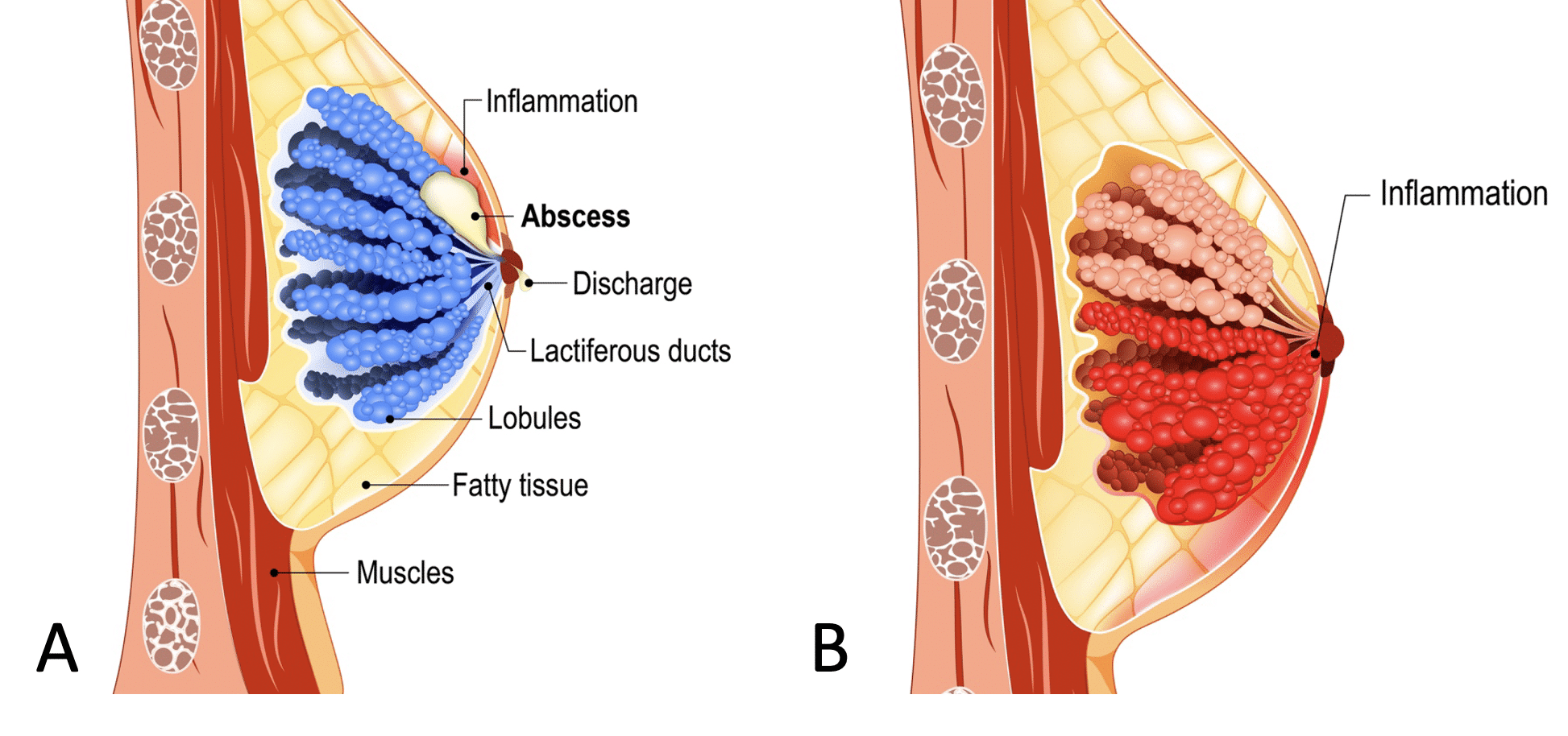 Front view of female breast anatomy with a lump present, Stock