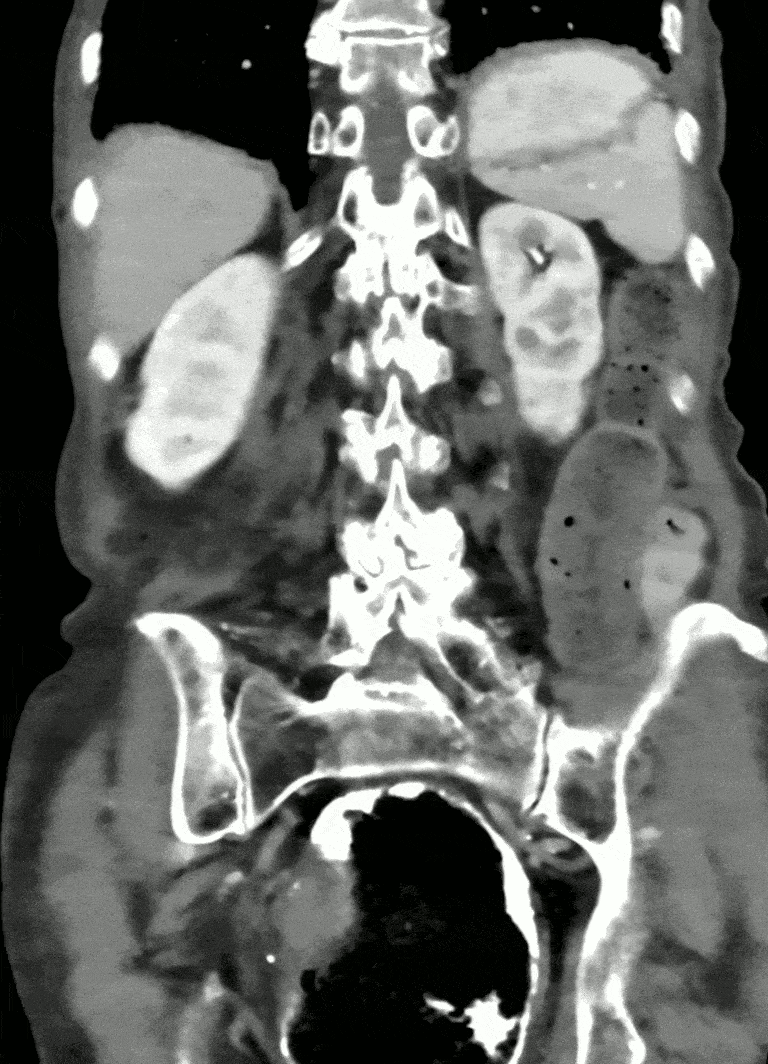 CT scan abdomen showing compression at D3 with dilated stomach and