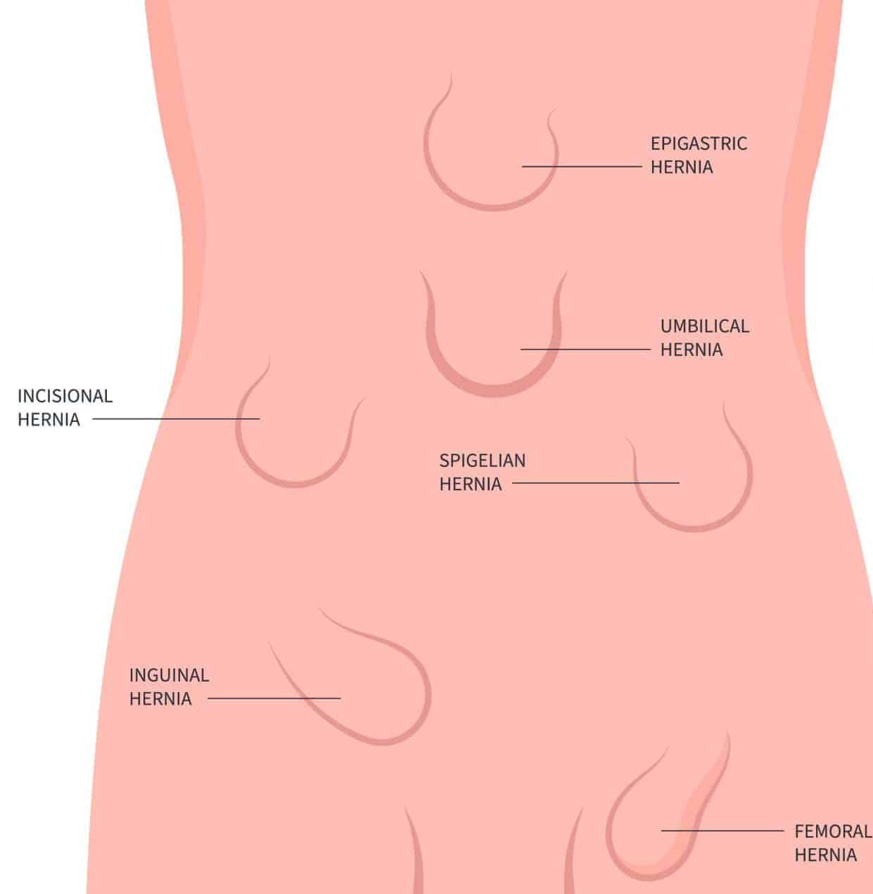 abdominal hernia in women